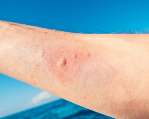 Qué hacer ante una picadura de medusa